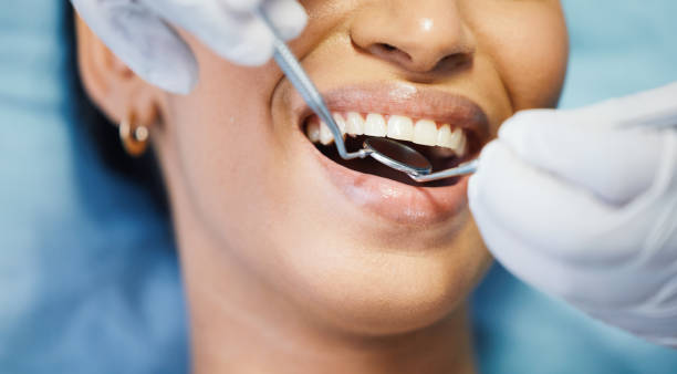 Best Knocked-Out Tooth (Avulsed Tooth) Treatment in Nampa, ID